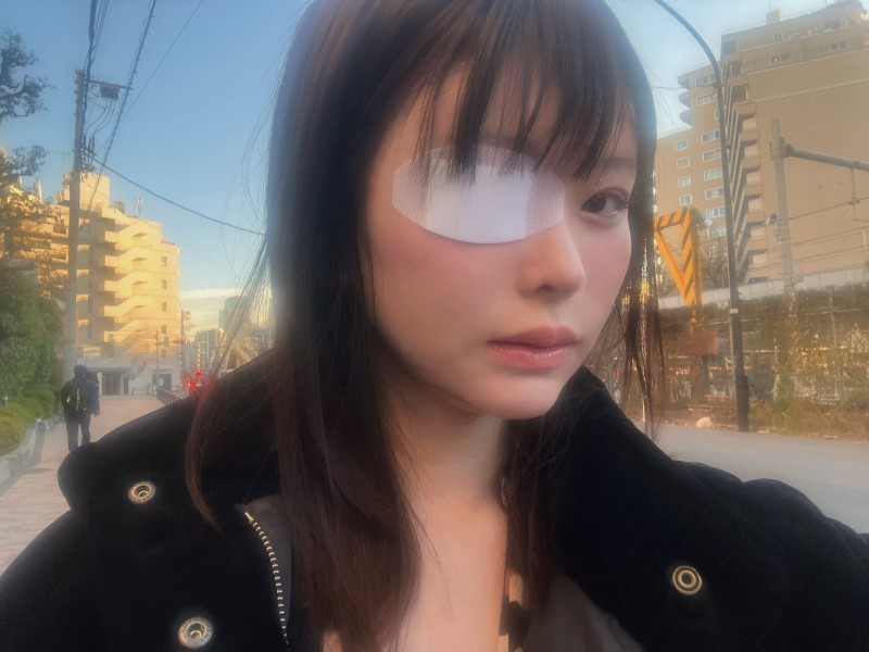 变成独眼龙!松本丽铃(原 明日见未来)被前男友打到受伤